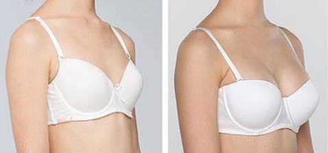 自体脂肪移植隆胸能维持多久?