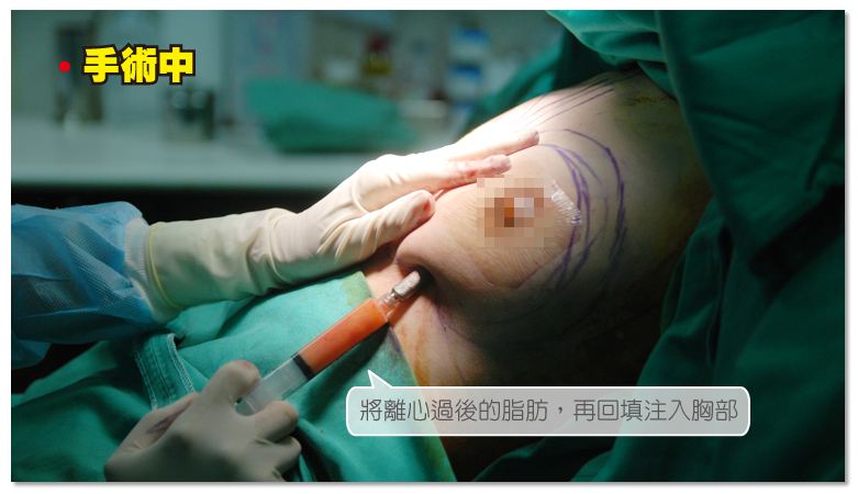 自体脂肪移植隆胸能维持多久?