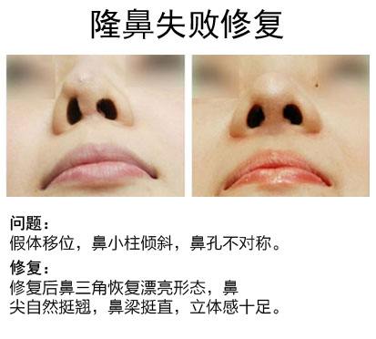 隆鼻失败修复手术后*果好吗?有哪些方法修复