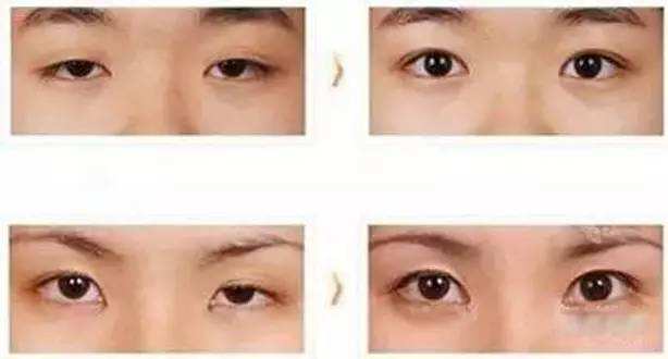大小眼能做双眼皮手术吗?做双眼皮能改善大小