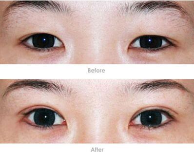 大小眼能做双眼皮手术吗?做双眼皮能改善大小