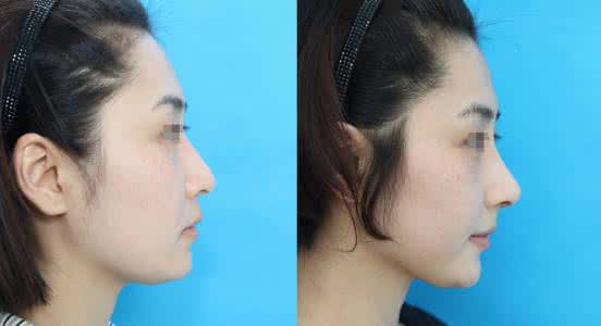 隆鼻失败修复术需要多久恢复?