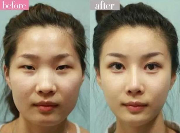 真想不到割一次双眼皮,竟然解决七大问题!
