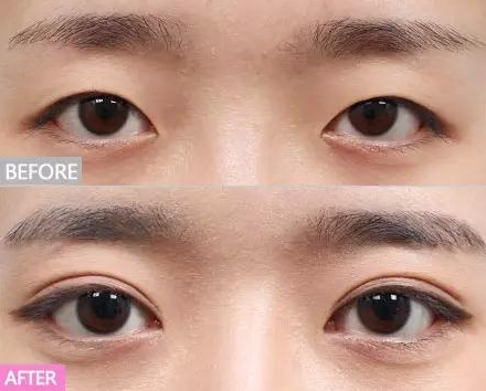 真想不到割一次双眼皮,竟然解决七大问题!