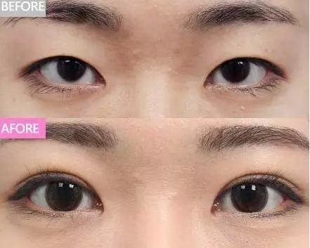 真想不到割一次双眼皮,竟然解决七大问题!