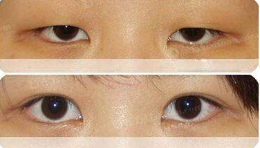 真想不到割一次双眼皮,竟然解决七大问题!