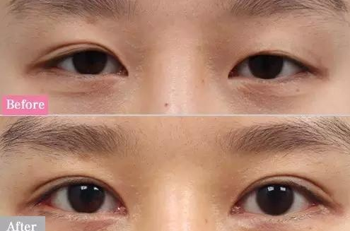 真想不到割一次双眼皮,竟然解决七大问题!