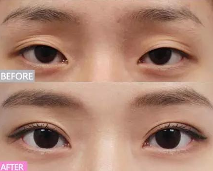 真想不到割一次双眼皮,竟然解决七大问题!