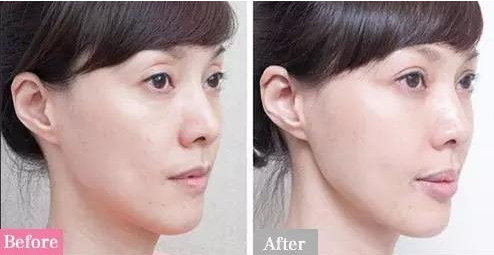 真想不到割一次双眼皮,竟然解决七大问题!