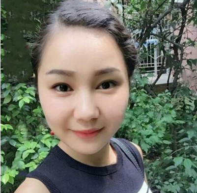 双眼皮术后常见的三个问题,看看你是不是想要