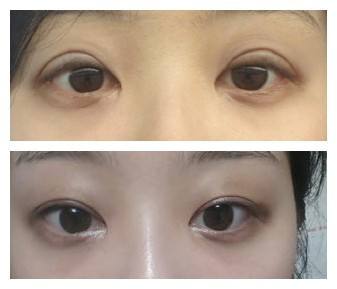 什么情况下双眼皮需要修复?双眼皮修复难吗?