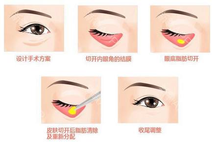 去眼袋,内切法和外切法有什么区别?