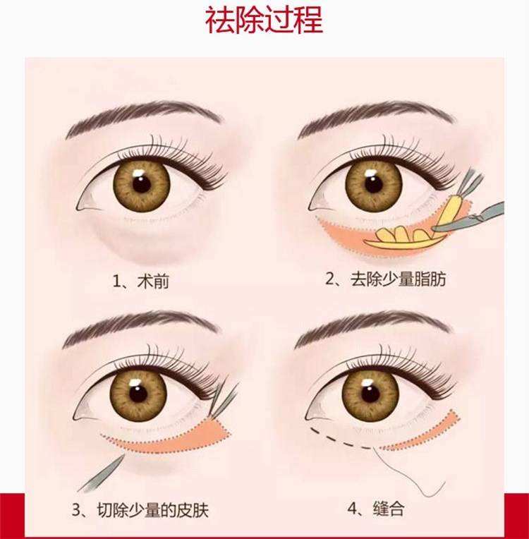 去眼袋,内切法和外切法有什么区别?