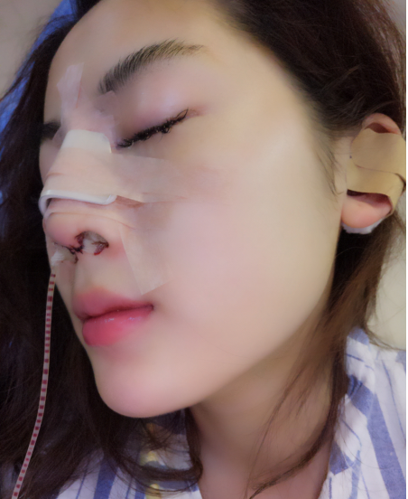 隆鼻后鼻尖会发白是怎么回事?真人案例分享