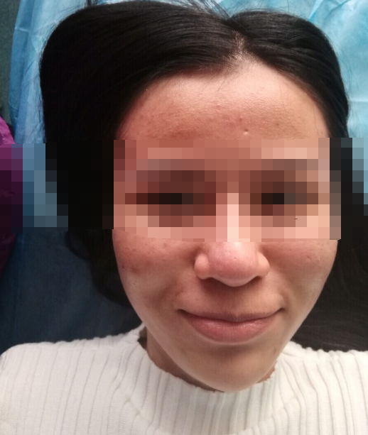 武汉爱思特做下颌角整形的价格是多少?