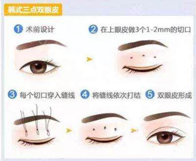 创伤越小的双眼皮手术方法就越好?——尽美网