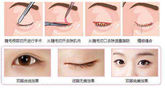 创伤越小的双眼皮手术方法就越好?——尽美网
