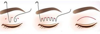 创伤越小的双眼皮手术方法就越好?——尽美网