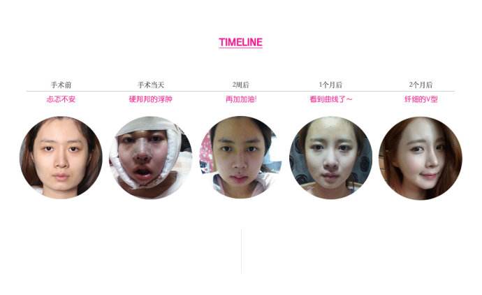 什么是轮廓三件套?术后有哪些后遗症?