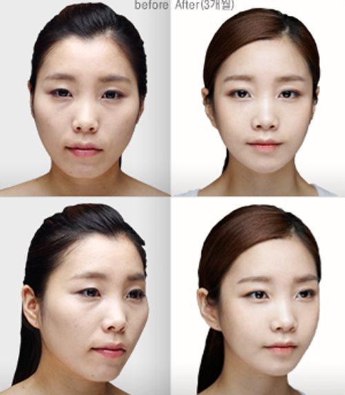 什么是轮廓三件套?术后有哪些后遗症?