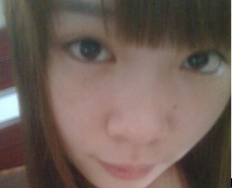 爱尔丽医生黄梅祛雀斑双激光,3次5000