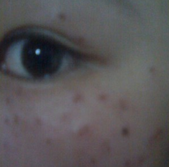 爱尔丽医生黄梅祛雀斑双激光,3次5000