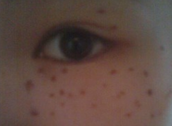 爱尔丽医生黄梅祛雀斑双激光,3次5000