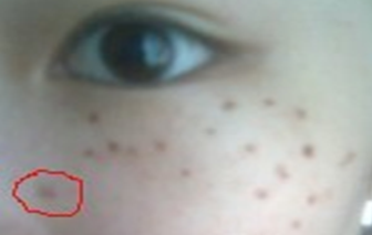 爱尔丽医生黄梅祛雀斑双激光,3次5000