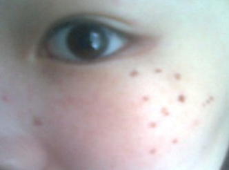 爱尔丽医生黄梅祛雀斑双激光,3次5000