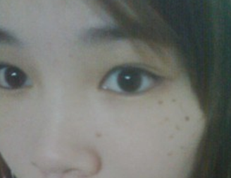 爱尔丽医生黄梅祛雀斑双激光,3次5000