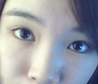 爱尔丽医生黄梅祛雀斑双激光,3次5000