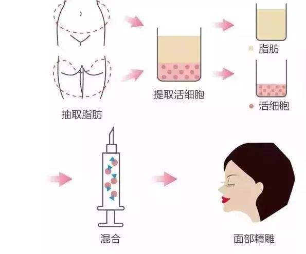 自体脂肪填充后,过段时间就会吸收代谢完吗?