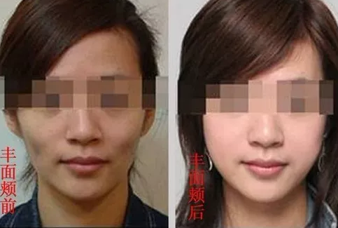 自体脂肪填充——锁住青春,留住岁月