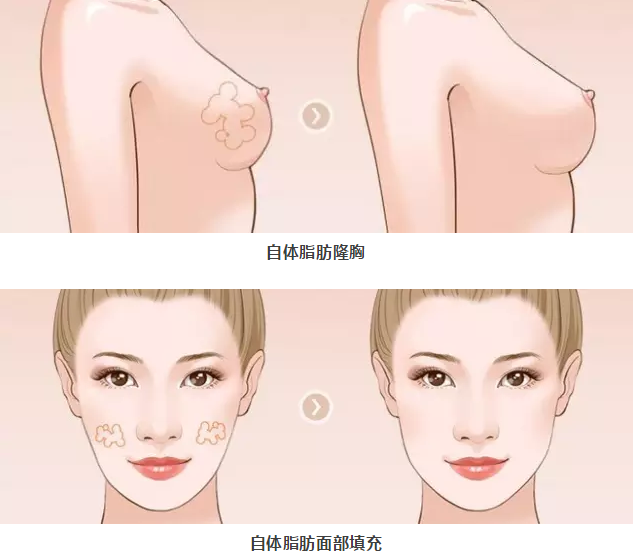 自体脂肪填充,变肥为宝!