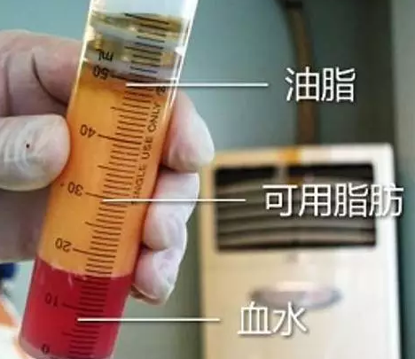 自体脂肪填充,变肥为宝!