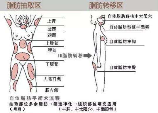 自体脂肪填充,变肥为宝!