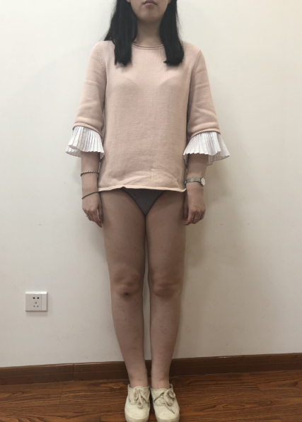 乌鲁木齐大腿吸脂80多天,小姐姐说的*果很满意