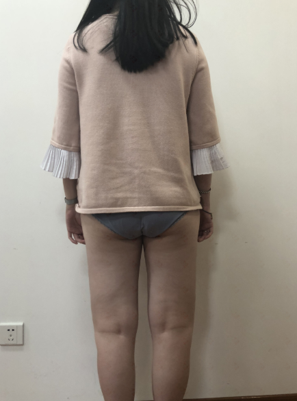 乌鲁木齐大腿吸脂80多天,小姐姐说的*果很满意