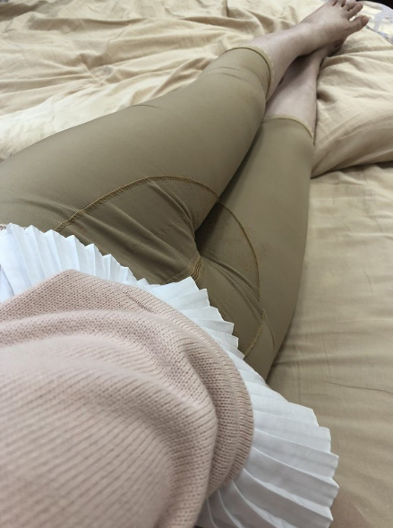 乌鲁木齐大腿吸脂80多天,小姐姐说的*果很满意