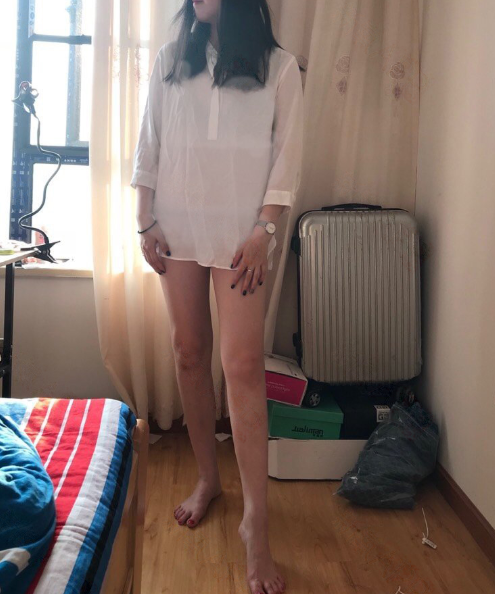 乌鲁木齐大腿吸脂80多天,小姐姐说的*果很满意