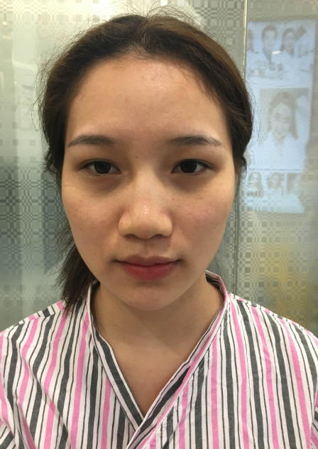 广州自体脂肪填充面部第三天的*果,附上该地