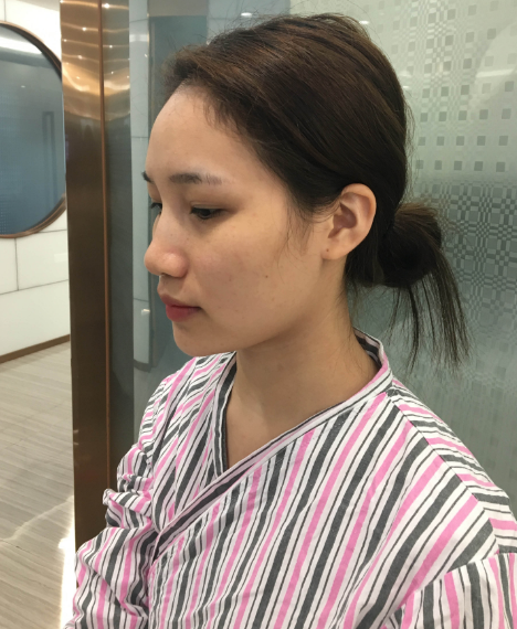 广州自体脂肪填充面部第三天的*果,附上该地