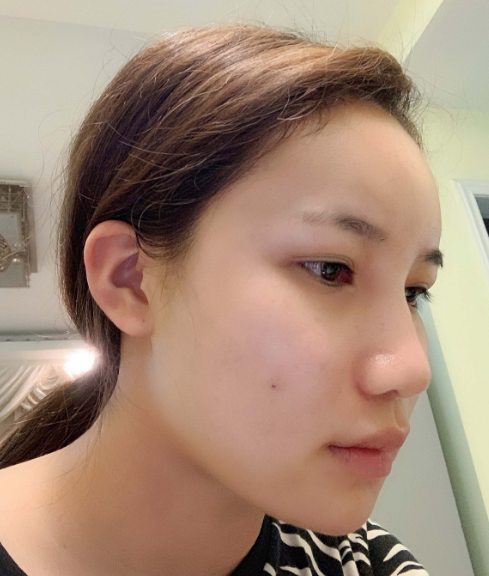 广州自体脂肪填充面部第三天的*果,附上该地