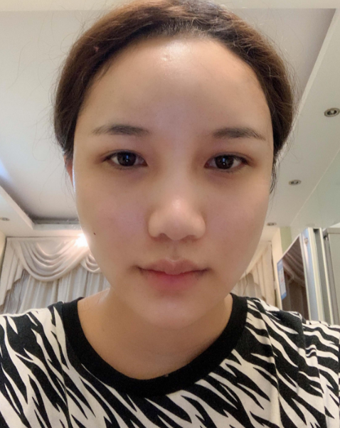 广州自体脂肪填充面部第三天的*果,附上该地