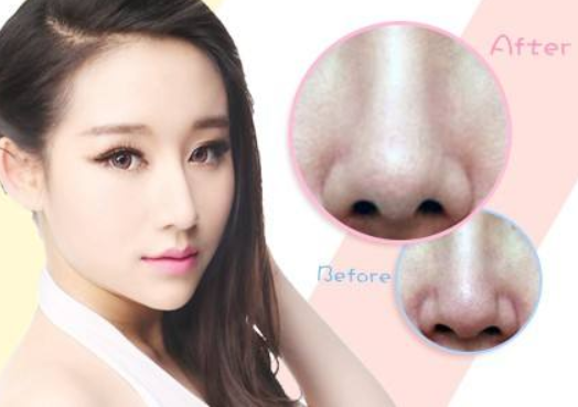 隆鼻失败很可怕,找对医生修复很关键