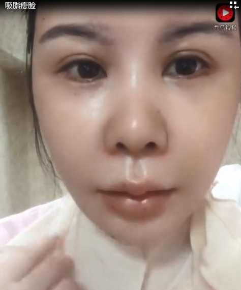 在成都做的面部吸脂,前面三天很肿,消肿后会