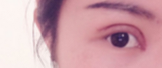 在成都天之美做的双眼皮,刘宁主刀,恢复情况