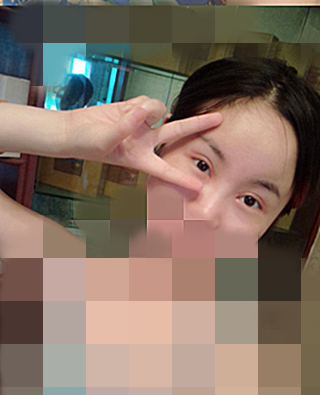 在成都天之美做的双眼皮,刘宁主刀,恢复情况