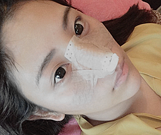 初次了解隆鼻,有6个问题常被问到