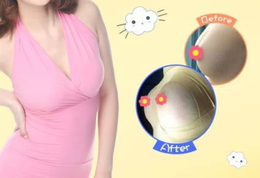 自体脂肪隆胸 vs 假体隆胸,选哪个好?